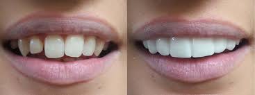  Dental Veneers